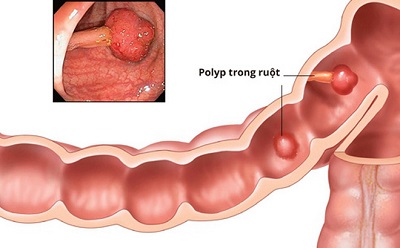 Tại sao bị polyp đại tràng